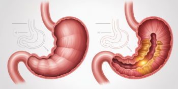 Úlcera Estomacal: O Desconforto Que Pode Virar um Perigo Silencioso